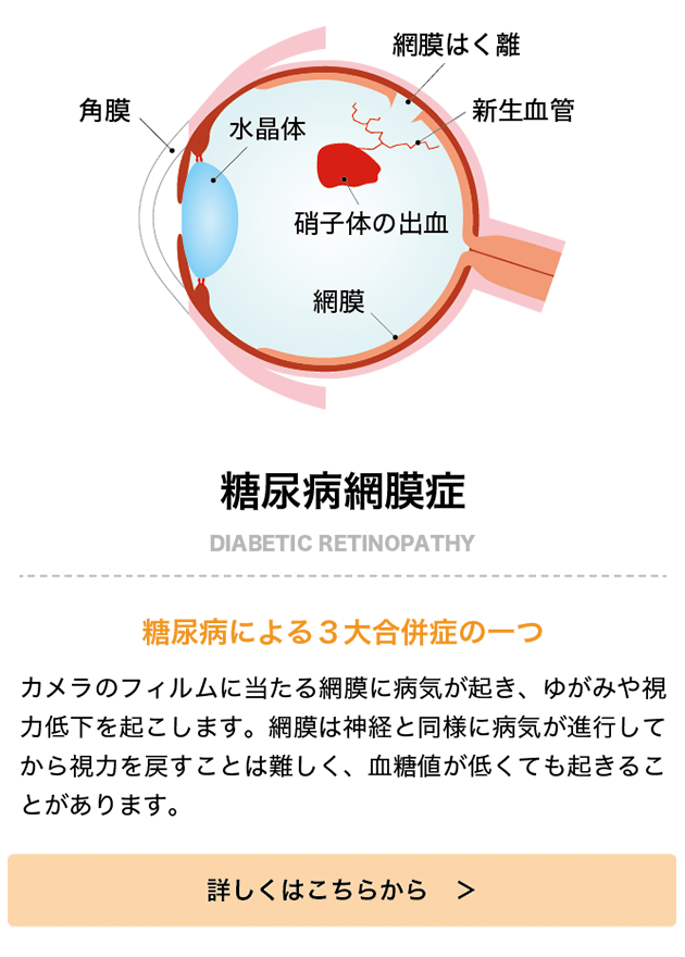 糖尿病網膜症手術